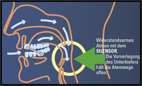 sind die Atemwege frei und das Schnarchgeräusch kann nicht entstehen